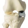 model_oxford_partial_knee.jpg model_oxford_partial_knee.jpg
